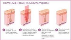 How-Laser-hair-removal-works - The Beauty and Cosmetic Clinic @ 70 Pitt St