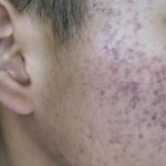 CBD Beauty acne-pigmentation