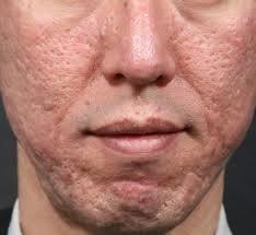 The Beauty Clinic acne-scarring