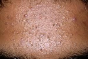 CBD Cosmetics comedonal-acne