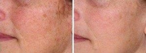 laser skin resurfacing - Sydney