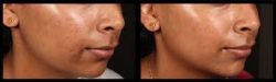 skin-needling-before-and-after