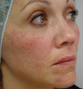 IPL_Limelight_Pigment_Removal_Before