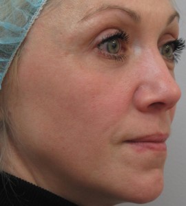 IPL_Limelight_Pigment_Removal_After
