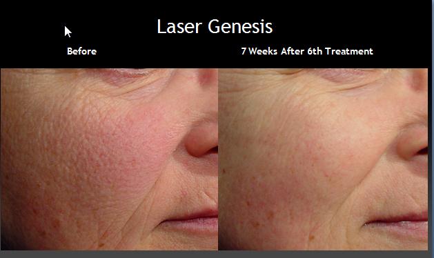 Cutera Laser Genesis The Beauty And Cosmetic Clinic 70 Pitt St
