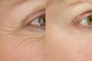 The Beauty clinic - ThermiSmooth - before and after