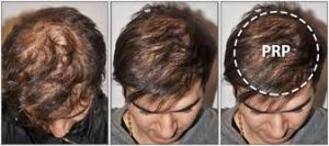 PRP-Hair-Restoration