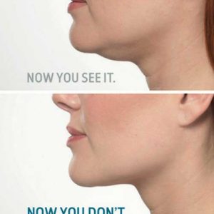 Chin-fat-before-and-after-2