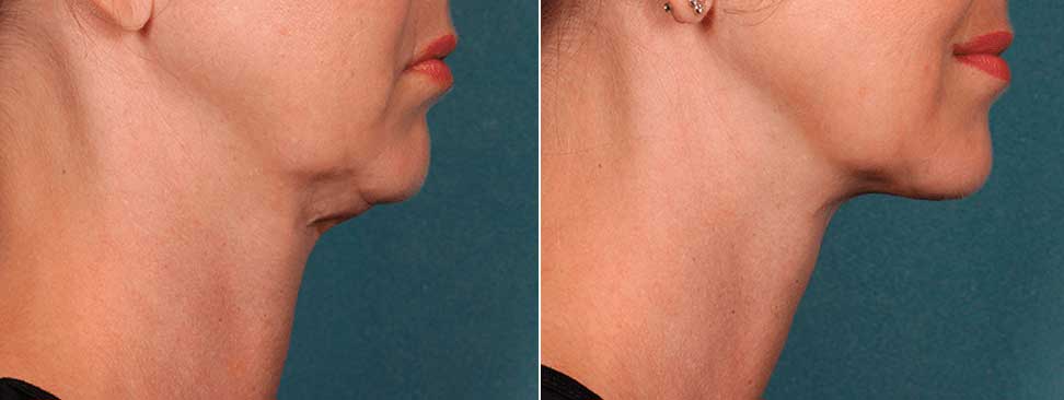 Chin-fat-before-and-after