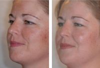 ydney_Beauty_glycolic_peel