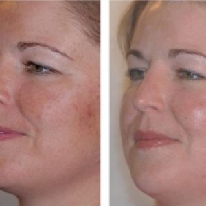 ydney_Beauty_glycolic_peel