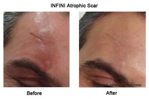 Infini-Atrophic-Scar-Sydney-Beauty-CBD