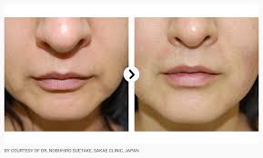 Ultraformer 3 skin tightening Harely Street - London Demasurge Clinic