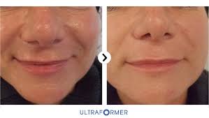Thebeautyclinic-ultraforma-sydney-cbd-city-before-and-after-4
