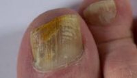 fungal-nail infections-sydney-beauty-cbd