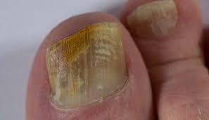 fungal-nail infections-sydney-beauty-cbd