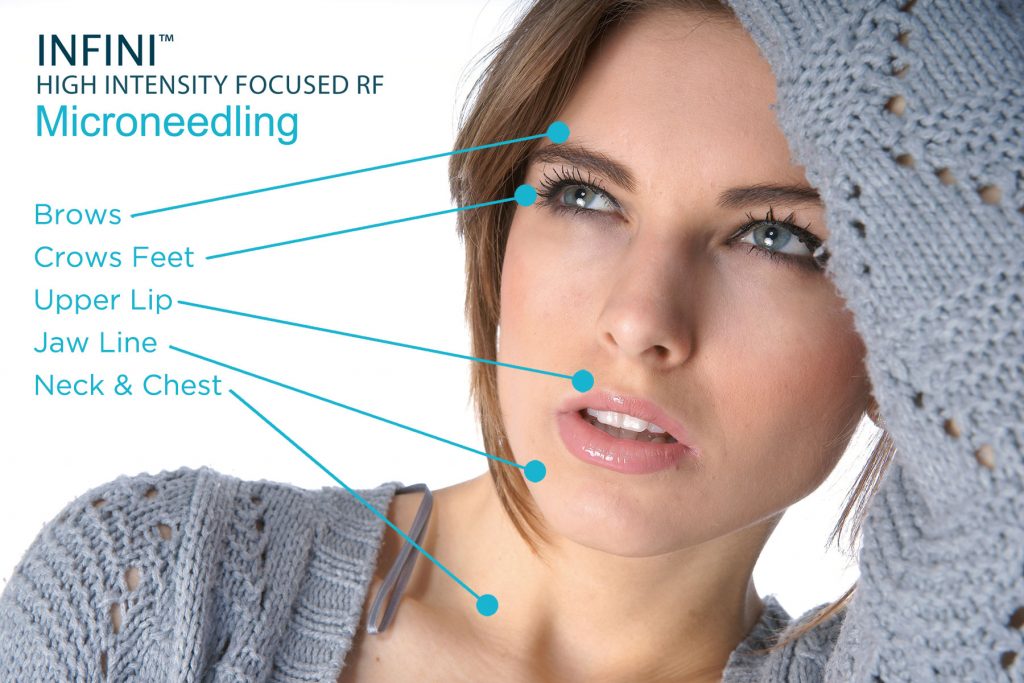 Microneedling-radio-requency-infini-Treatmen-the-beauty-and-cosmetic-clinic-sydney