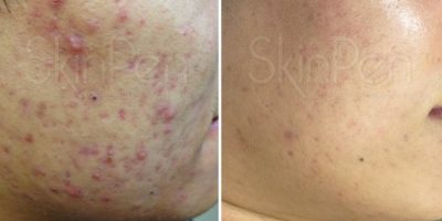b-a-acne2-Sydney-Cosmetic-Clinic-cbd