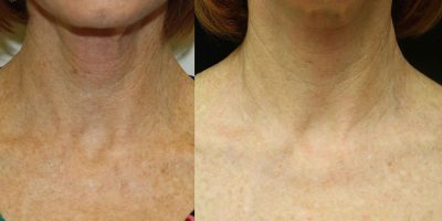Neck-and-chest-rejuvenation-The-Beauty-and-Cosmetic-Clinic-Sydney-CBD-2