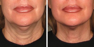 Neck-and-chest-rejuvenation-The-Beauty-and-Cosmetic-Clinic-Sydney-CBD-3