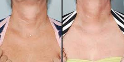 Neck-and-chest-rejuvenation-The-Beauty-and-Cosmetic-Clinic-Sydney-CBD-4