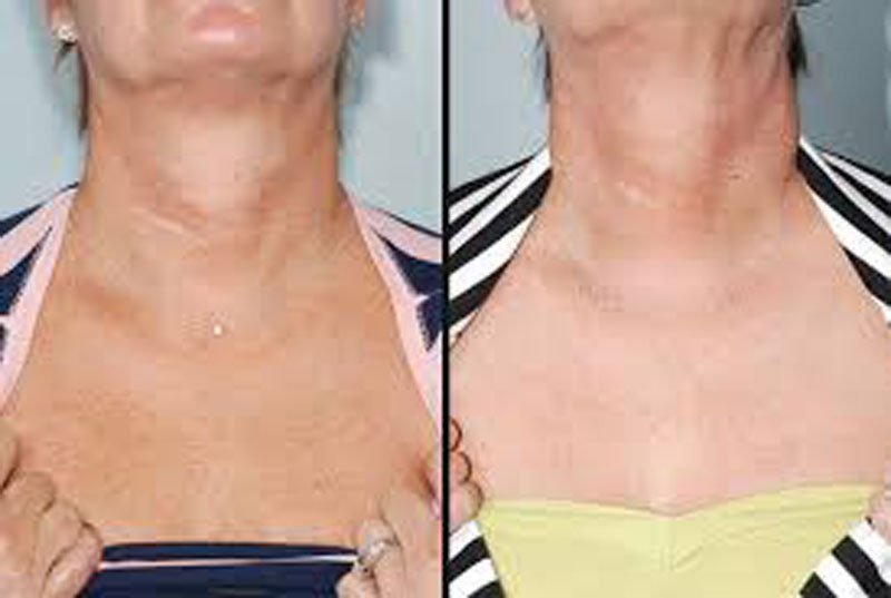 Patients-questions-Neck and Chest Rejuvenation - The Beauty and