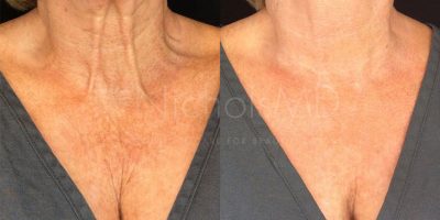 Neck-and-chest-rejuvenation-The-Beauty-and-Cosmetic-Clinic-Sydney-CBD