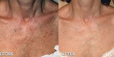 Neck-and-chest-rejuvenation-The-Beauty-and-Cosmetic-Clinic-Sydney-CBD-5
