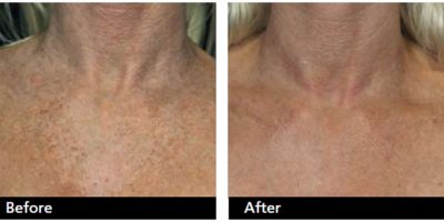 Neck-and-chest-rejuvenation-The-Beauty-and-Cosmetic-Clinic-Sydney-CBD-6