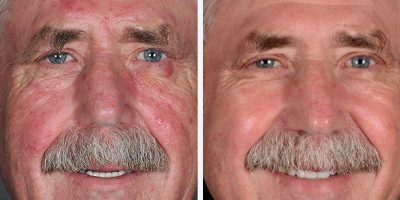 Rosacea-The-Beauty-and-Cosmetic-Clinic-Sydney-CBD-4