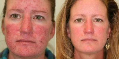 Rosacea-The-Beauty-and-Cosmetic-Clinic-Sydney-CBD
