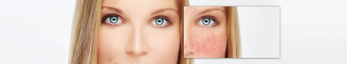 Rosacea-The-Beauty-and-Cosmetic-Clinic-Sydney-CBD