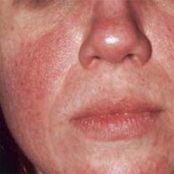 Rosacea-The_Beauty-and-cosmetic-clinic-sydney-city