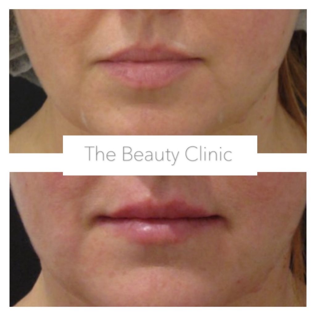 Lip_filler_our_results