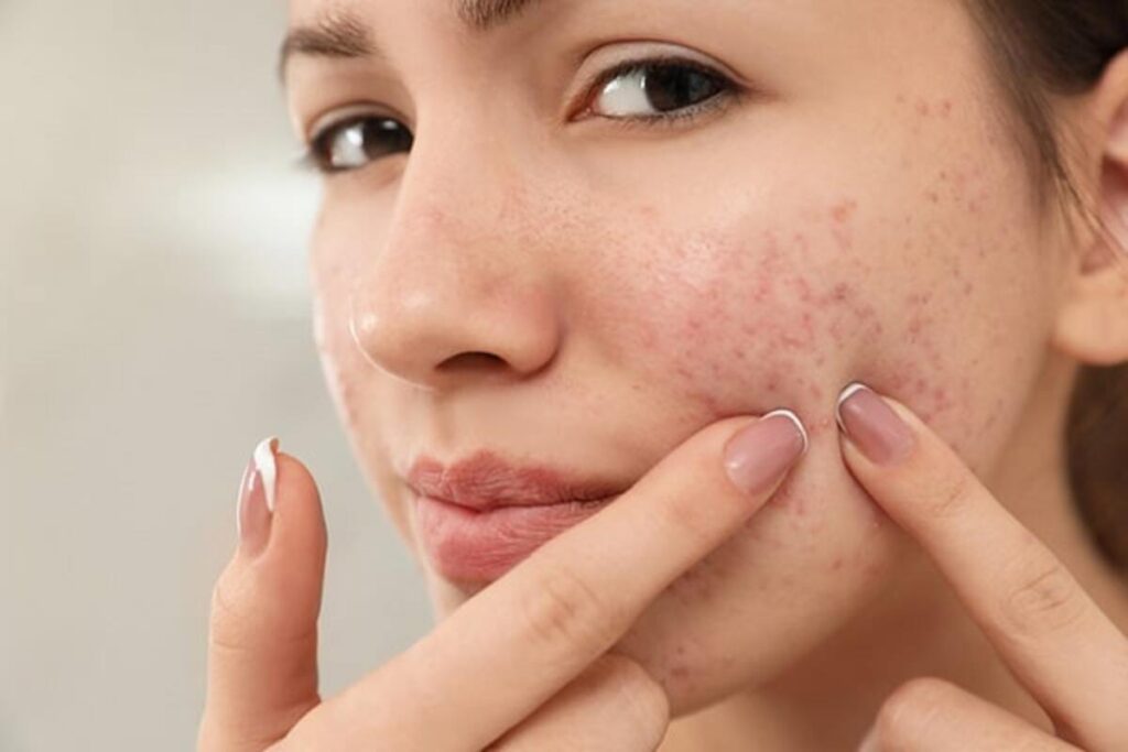 The Beauty abd Cosmetic Clinic -Meso Acne Treatment