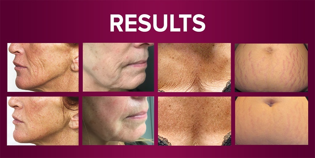 The Beauty Clinic Skin Re-Vitalizing Peel