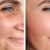 non-surgical-facelift-1