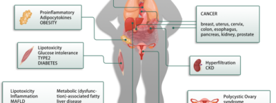 insulin resistance