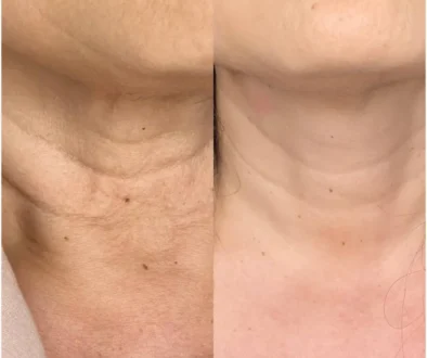 neck-rejuvenation-profihilo-treatment